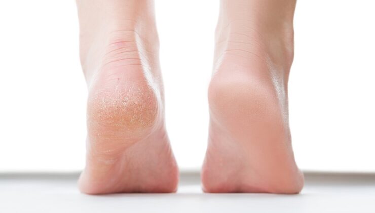 Flexitol Topuk Balsamı Kuru, Çatlak, Nasırlı Ayakları Kurtarıyor